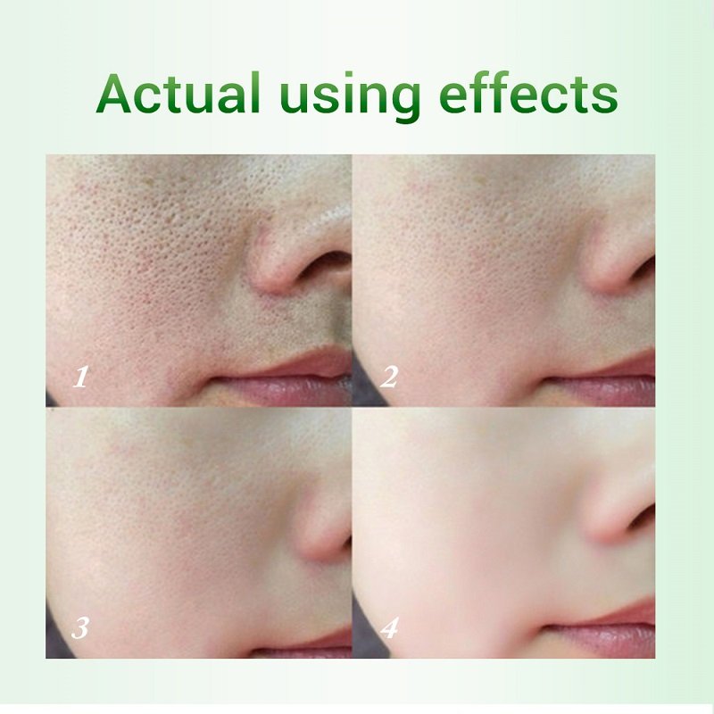 Salicylic Acid Pore Refinement Cream Lotion Skin Rejuvenation Cream Skin Care Products - Image 10